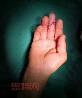 空手指恐怖图像解析：从心理学角度看密集恐惧症